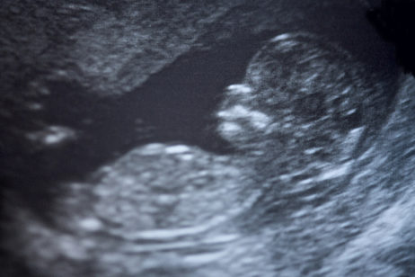 Ultrasound scan of a twelve week old fetus.
