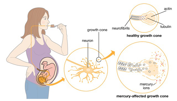 Mercury poisoning of unborn baby graphic